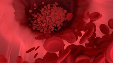 How Has Stroke Treatment Changed?