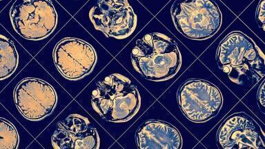 Enzyme Suppression Technique shows Potential for Alzheimer’s Treatment