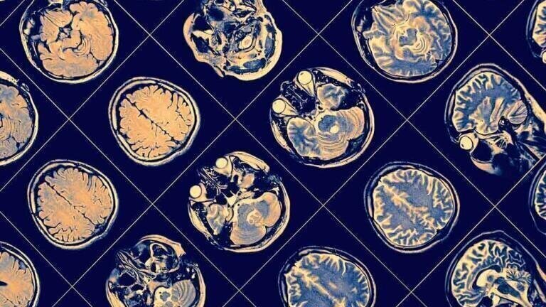 Enzyme Suppression Technique shows Potential for Alzheimer’s Treatment