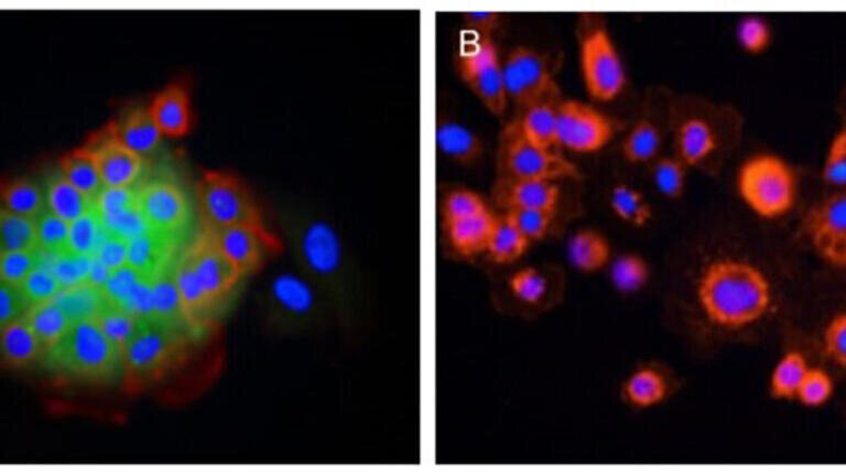 Immunocytochemical analysis of human primary prostate cancer cells in vitro. EGFR expression (red) and pan-Cytokeratin expression TP53 (green), DAPI (blue).