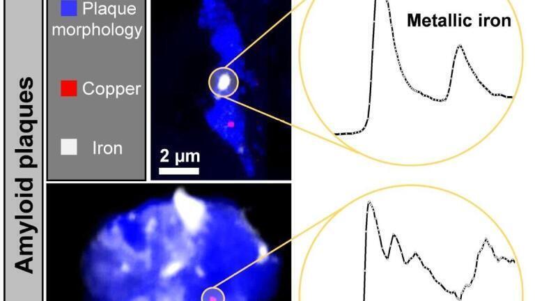 X-ray microscope images and x-ray absorption spectra obtained from two Alzheimer's disease plaque cores, measured at Diamond Light Source beamline I08. X-images showed the plaques to contain both iron and copper deposits. X-ray absorption spectra from the highlighted regions were consistent with metallic elemental iron (top spectrum) and copper (bottom spectrum)
Credit: University of Warwick
