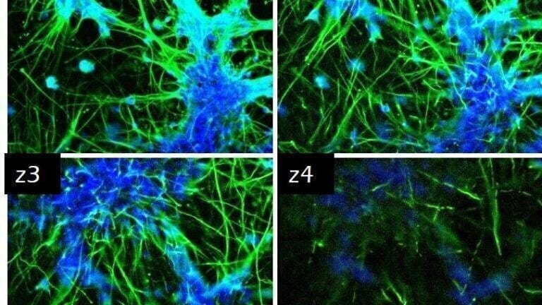 Neural stem cell differentiation - 25,000 iPSC derived neural stem cells were cultured in TrueGel3D® HTS Hydrogels and allowed to differentiate over 7-15 days. Differentiated cells show neural phenotypes with increased TUJ-1 expression (green) and complex neural networks. 
