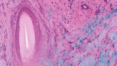 Using Fluorescence Imaging for Improved Outcomes in Skin Cancer Surgery