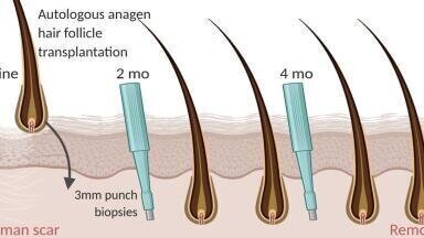 Transplanted Hair offers hope for Skin Rejuvenation