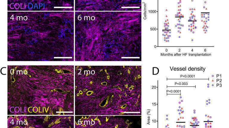 Figs 3a & b – Microscope images and graph of skin cell density (blue) at 0, 2, 4 and 6 months post-transplant. Reveals an increase in skin cells over time.
Figs 3c & d - Microscope images and graph of blood vessel density (yellow) at 0, 2, 4 and 6 months post-transplant. Reveals an increase in blood vessels over time. Plotczyk et al., Nature Regenerative Medicine
