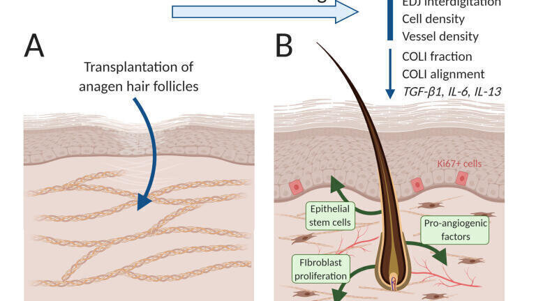 Fig 6 – Schematic of results showing how the transplants promoted scar rejuvenation. The treated scarred skin harboured new cells and blood vessels, remodelled collagen to restore healthy patterns and expressed genes found in healthy unscarred skin Plotczyk et al., Nature Regenerative Medicine