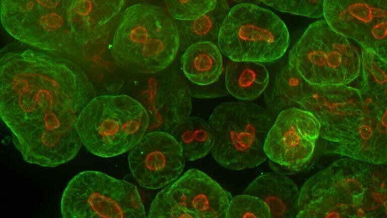 Tumoroid (also known as cancer organoid) cells established from a patient colorectal cancer sample are shown expressing proteins associated with cancer identity (green) and proliferation (red).