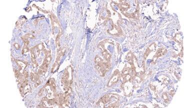 Custom monoclonal antibody reveals HER2+ breast cancer target