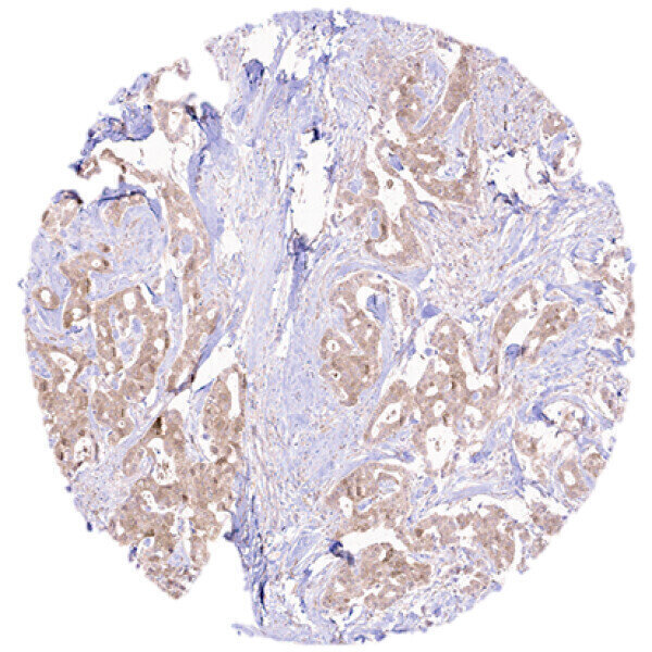 Custom Monoclonal Antibody Reveals HER2+ Breast Cancer Target - Vimarsana News