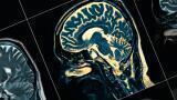 Collaboration to broaden understanding of Alzhemer’s diseases