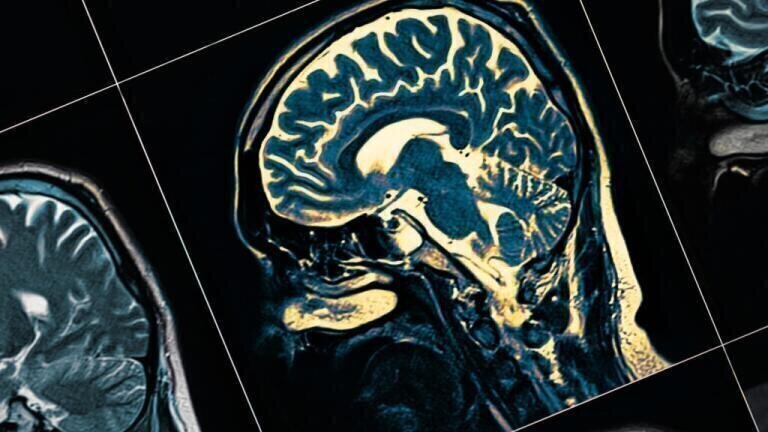 Collaboration to broaden understanding of Alzhemer’s diseases