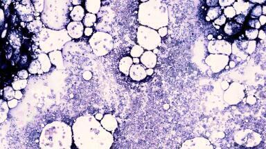Expanded partnership launches first digital bone marrow imaging and analysis