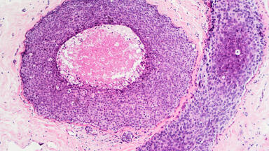 Validated tumour tissue samples for advanced cancer research