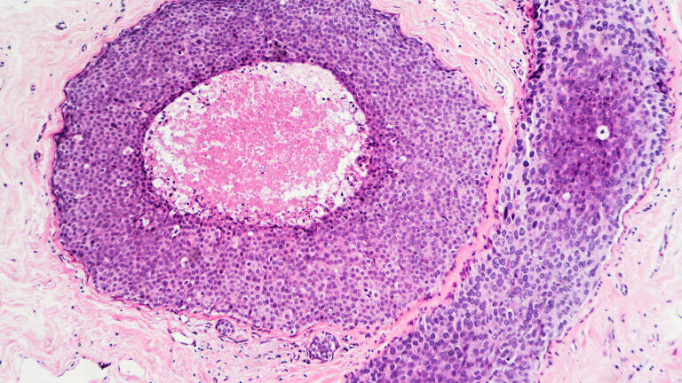 Validated tumour tissue samples for advanced cancer research