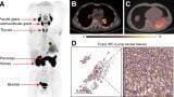 Novel radiotracer identifies critical cancer biomarker, opens door to new therapeutic target for solid tumours