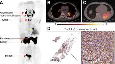 Novel radiotracer identifies critical cancer biomarker, opens door to new therapeutic target for solid tumours