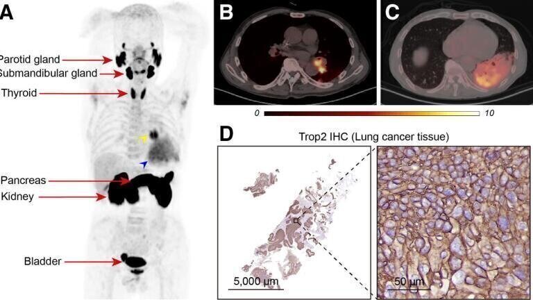 Novel radiotracer identifies critical cancer biomarker, opens door to new therapeutic target for solid tumours