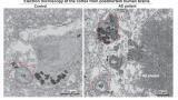 Researchers identify key cellular mechanism driving progression of Alzheimer's disease