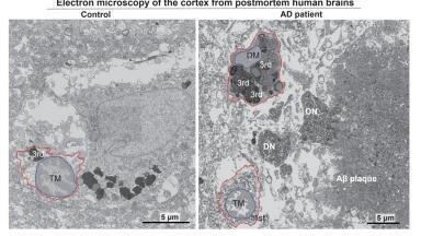 Researchers identify key cellular mechanism driving progression of Alzheimer's disease