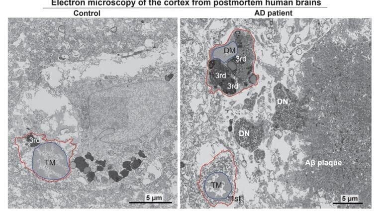Researchers identify key cellular mechanism driving progression of Alzheimer's disease