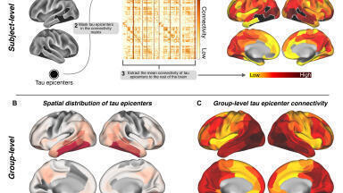 Detangling tau: Patient scans reveal how amyloid and tau proteins work in tandem in Alzheimer’s disease
