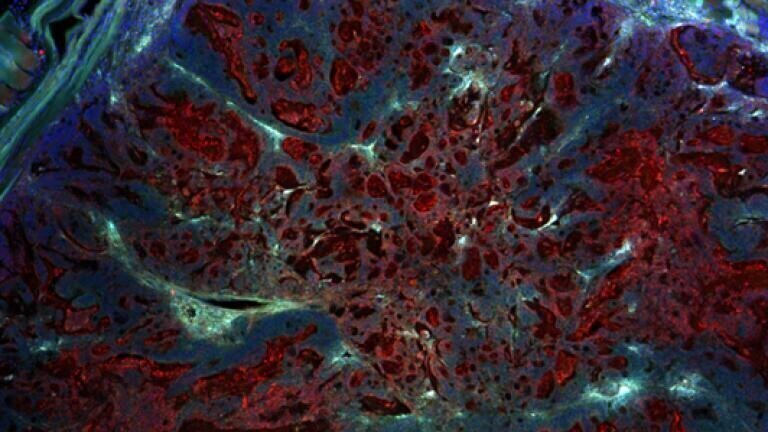 Proliferation of transplanted colorectal cancer cells (red), stroma tissue (green) and cell nuclei (blue) in MatriMix for PDX.