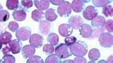 Epstein-Barr virus more closely linked to progression of multiple sclerosis 