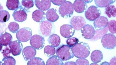 Epstein-Barr virus more closely linked to progression of multiple sclerosis 
