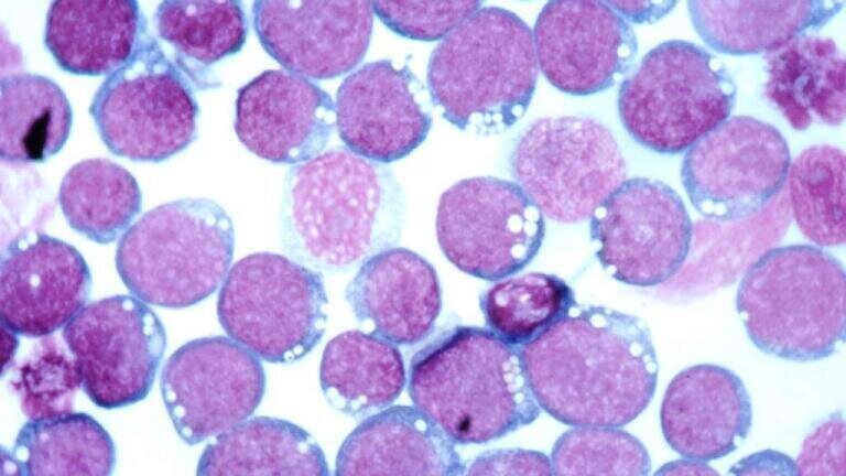 Epstein-Barr virus more closely linked to progression of multiple sclerosis 