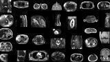 Artificial intelligence model automatically segments MRI scans