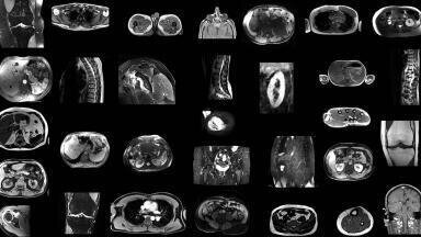 Artificial intelligence model automatically segments MRI scans