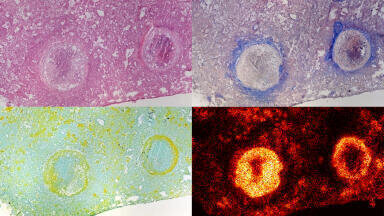 Tuberculosis bacteria hiding in dead lung tissue can be treated by novel antibiotic