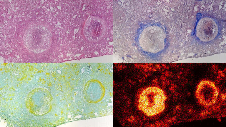 Tuberculosis bacteria hiding in dead lung tissue can be treated by novel antibiotic
