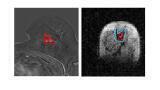 Breakthrough scanner detects hidden cancer spread