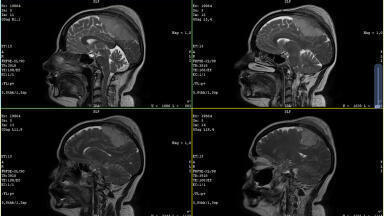 Biomarker found that predicts a cancer’s ‘aggressiveness’