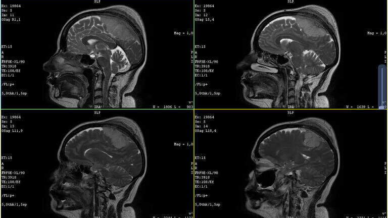 Biomarker found that predicts a cancer’s ‘aggressiveness’