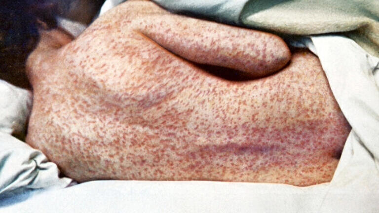 US measles outbreak: is it the next pandemic’s pathogen of choice?
