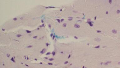 Bacteria behind dental gingivitis may cause cardiac scarring and trigger AF