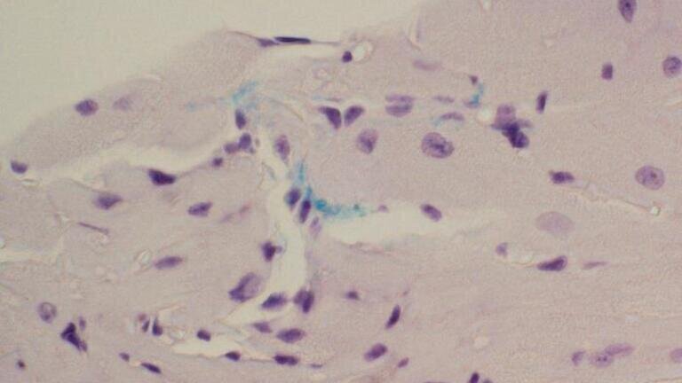 Bacteria behind dental gingivitis may cause cardiac scarring and trigger AF
