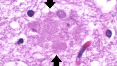 Drug that slows progess of Alzheimer’s disease shown to be well tolerated in clinical setting