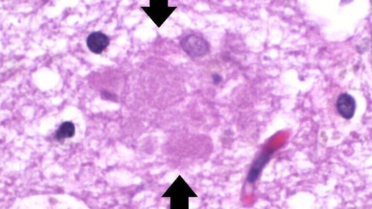 Drug that slows progess of Alzheimer’s disease shown to be well tolerated in clinical setting