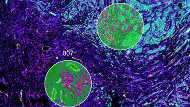Finnish study identifies gene test to guide cancer immunotherapy