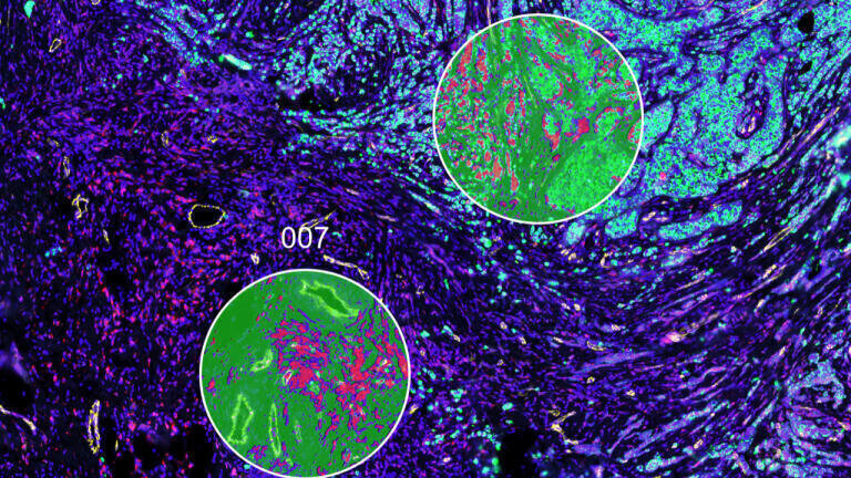 Finnish study identifies gene test to guide cancer immunotherapy