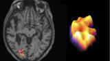 New biomarker offers hope for predicting multiple sclerosis progression