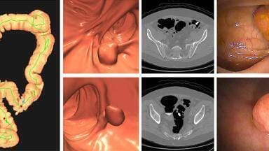CT colonography outperforms stool DNA screening for colorectal cancer 