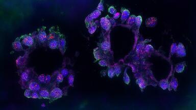 Link to triple-negative breast cancer identified in RNA study