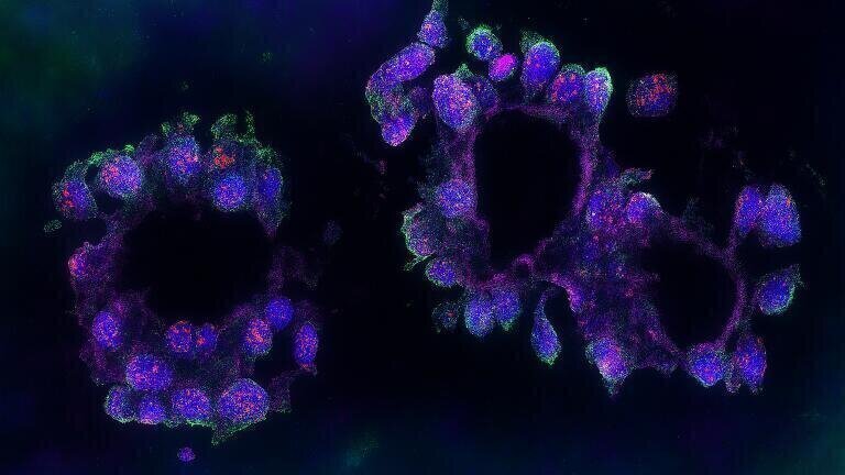 Link to triple-negative breast cancer identified in RNA study