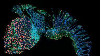 Preventing chronic inflammation from progressing to cancer of the bowel