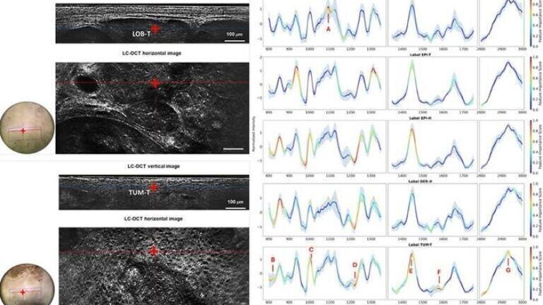 Dual-mode optical imaging system enables noninvasive skin cancer characterisation