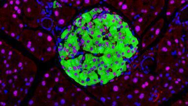 Single-gene linked to widespread type-2 diabetes via RNA disruption in insulin-producing cells